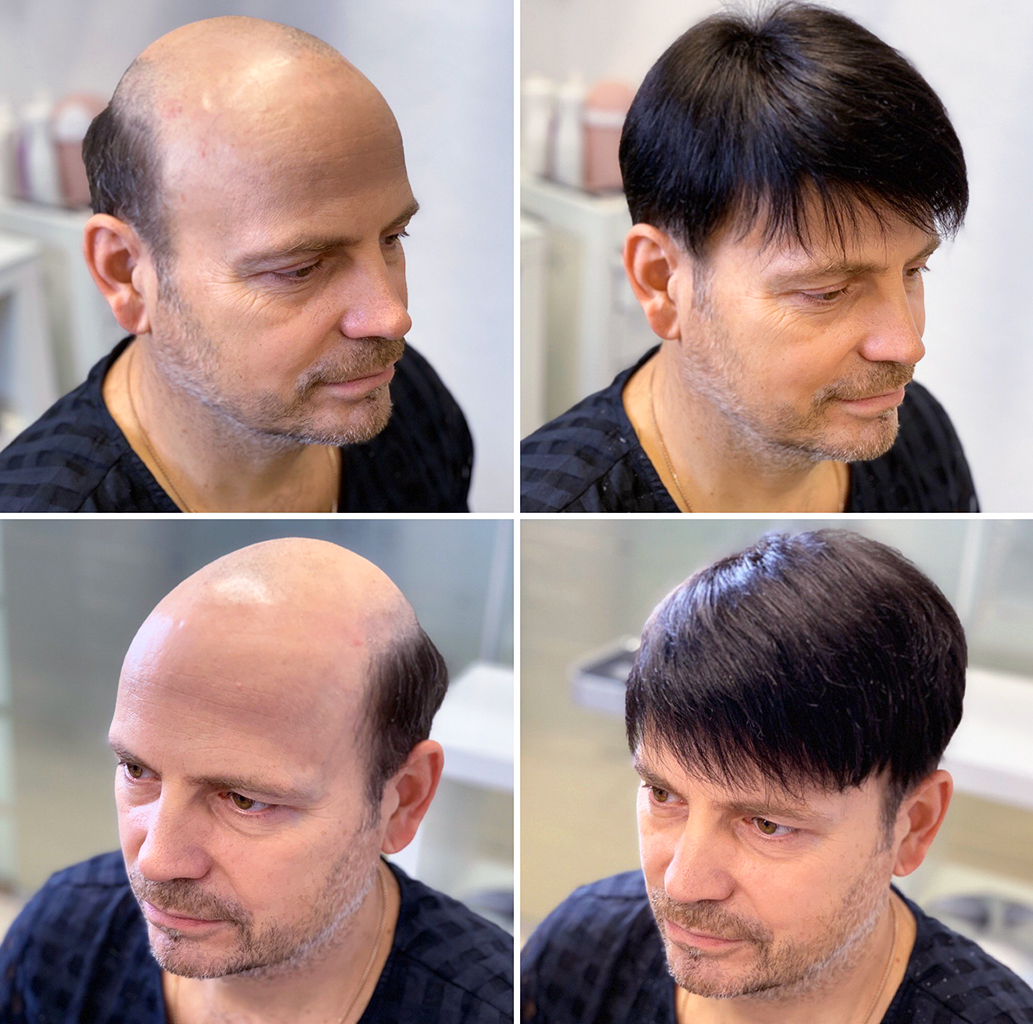 https://umnyevolosy.ru/wp-content/uploads/2021/12/Нарастили-систему-замещения-Nova-Hair-основа-25-на-195-см-длина-волос-10-см-тон-2-optimized.jpg